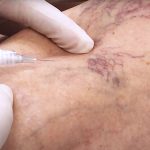 varis-tedavisi-yontemleri