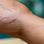 bacaklarda-morarma-varis