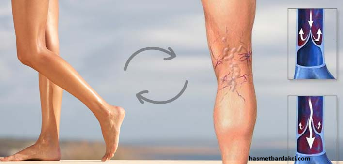 En-iyi-varis-tedavisi-yontemleri