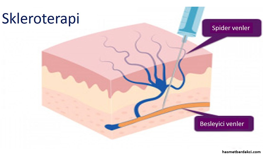 skleroterapi-nedir