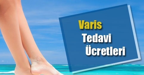 varis-tedavi-fiyatlari